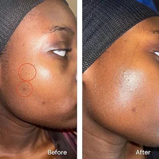 AWARD-WINNING Acne Cream - 4X STRONGER, 11X FASTER! Patented technology features Organic Salicylic Acid